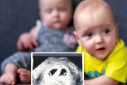 Aunque dar a luz gemelos nacidos de padres diferentes es un evento bastante raro, puede ocurrir. Es lo que se conoce como superfertilización o superfecundación heteropaterna.