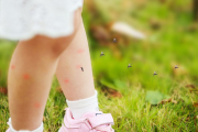 Las picaduras de los mosquitos en verano es uno de los mayores temores de todos los niños. Si nada ha podido evitar que les piquen, estos remedios os pueden servir para aliviar el picor y la hinchazón posterior.