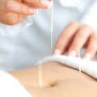 La acupuntura puede ser un método complementario eficaz en la búsqueda de embarazo.