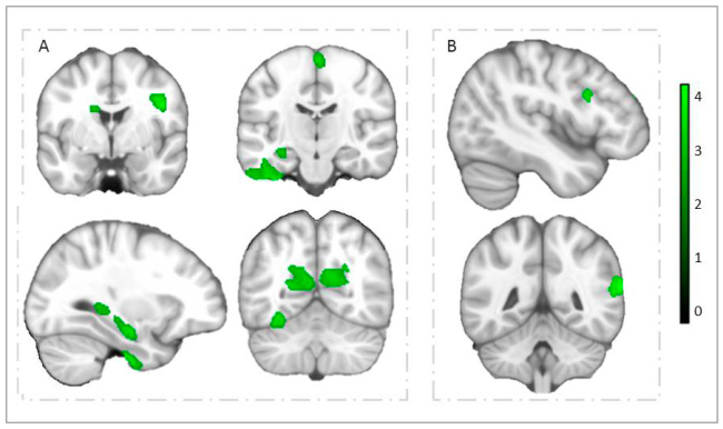 Regiones cerebrales que muestran asociaciones independientes positivas de velocidad cardiorrespiratoria y agilidad de velocidad con volumen de materia gris en niños con sobrepeso u obesidad.