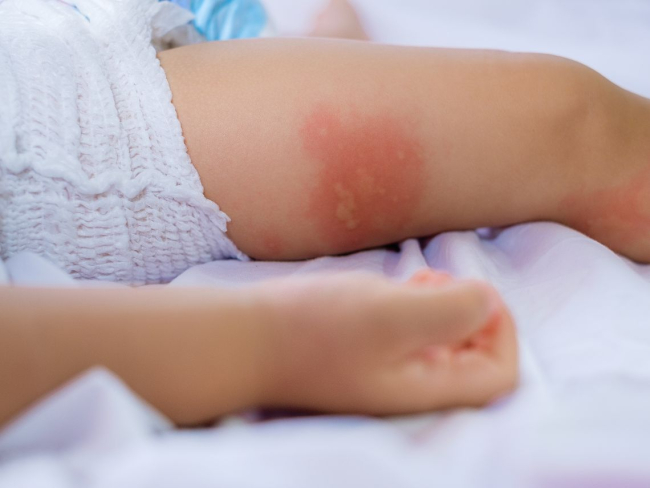 Erupciones comunes que pueden aparecer las piernas de los bebés