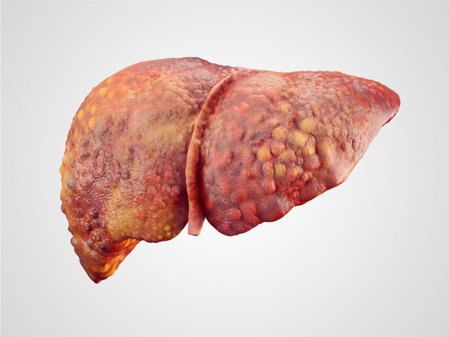 Hígado con cirrosis