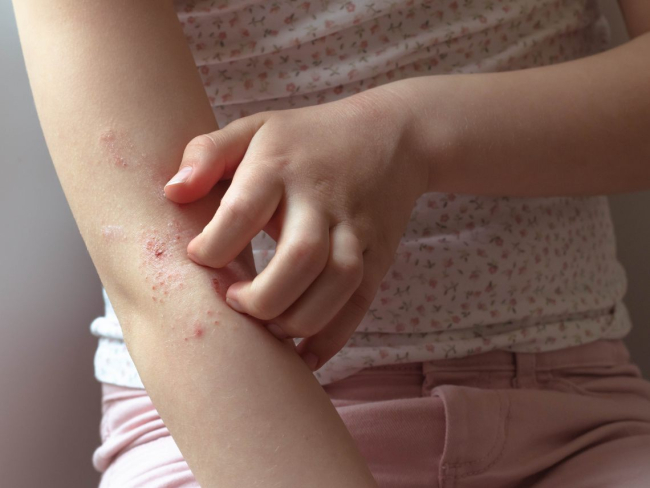 Mi peque tiene dermatitis atópica: es y para tratarla?